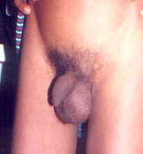 Bilateral vaginal hydrocele Grade 1