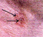 The early target lesion center hole, in the middle of an ischemic ring, surrounded by red tissue inflamation