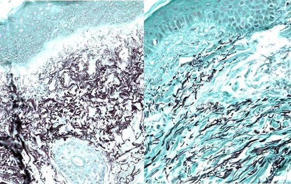 Elastic fibers are compacted and disorganized before and organized three months after MAL-PDT treatment 